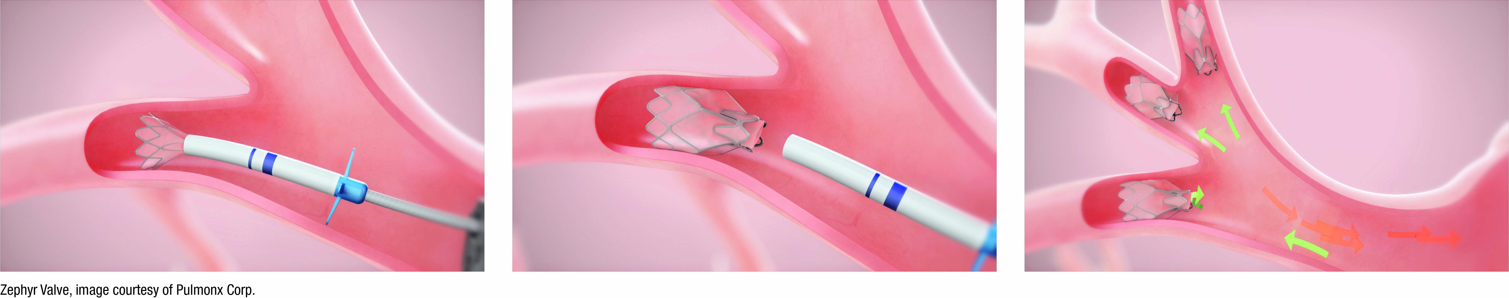 images of implanting device